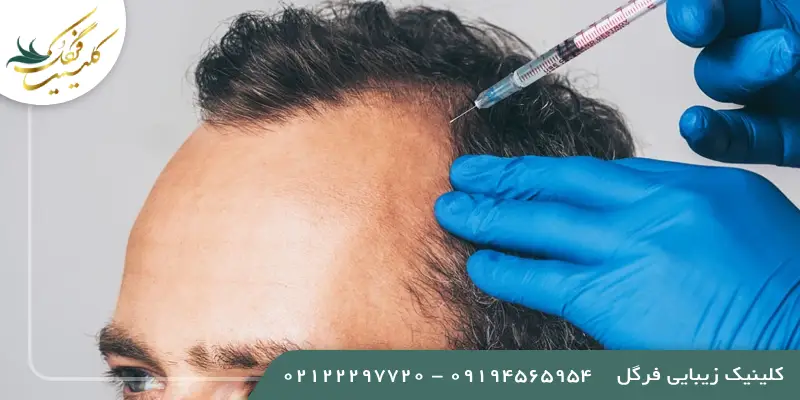 درمان ریزش مو و تقویت مو با پی آر پی
