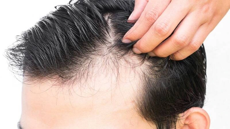 پی آر پی روش درمان ریزش مو