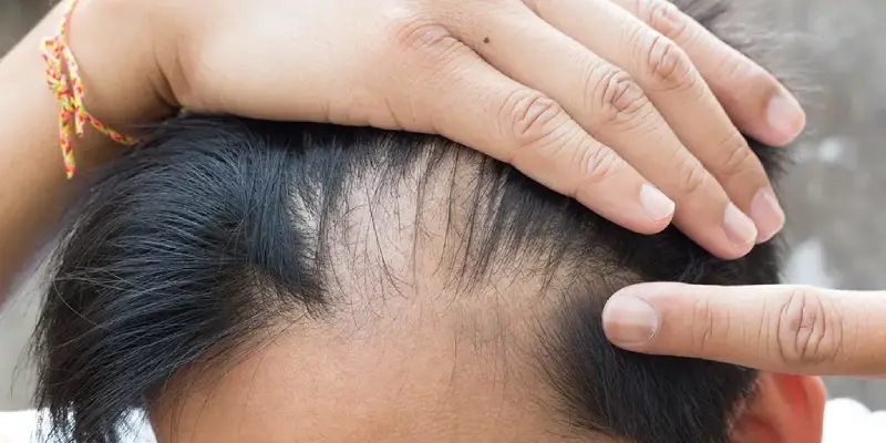 از کجا بفهمیم ریزش مو هورمونی است و علائم آن؟